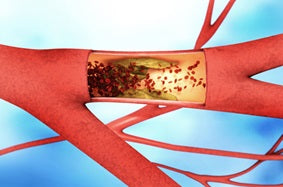 What is Arteriosclerosis and How Do I Prevent It?